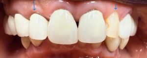 Before Image: Crown and Veneer