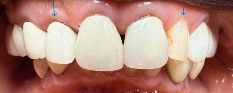 Before Image: Crown and Veneer - front