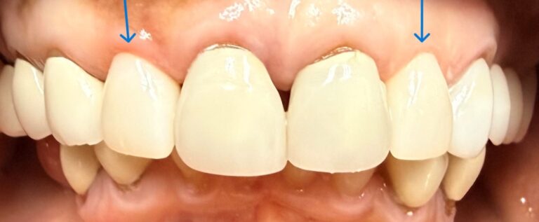 After Image: Crown and Veneer - front