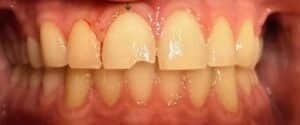 Before Image: 1 Front Veneer