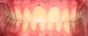 After Image: 1 Front Veneer