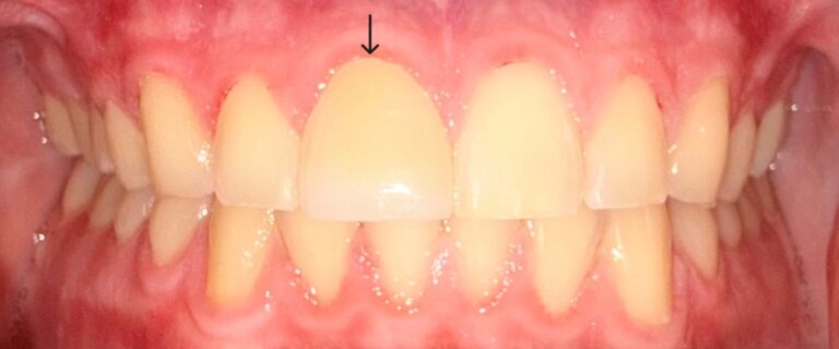 After Image: 1 Front Veneer - front