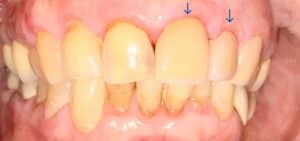 After Image: 2 Front Crowns