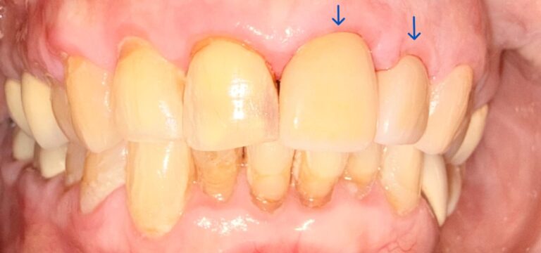 After Image: 2 Front Crowns - front