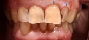Before Image: 2 Front Crowns